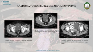 PROTOCOLO DE TC DE ABDOMEN Y PELVIS
 ANATOMÍA
PROTOCOLO
CONCLUSIONES
ANATOMÍA TOMOGRÁFICA DEL ABDOMEN Y PELVIS
Fig. 49.--1:vejiga; 2: útero; 3: recto; 4: vasos
ilíacos externos; 5: vasos ilíacos internos; 6:
músculo iliopsoas; 7: músculo piramidal.
1: vejiga; 2: recto; 3: vagina; 4: músculo obturador
interno; 5: arteria y vena femoral común.
1: recidiva tumoral de neo de recto; 2: músculo
piramidal infiltrado por la recidiva; 3: útero; 4: vejiga;
5:recto.
 