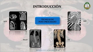 PROTOCOLO DE TC DE ABDOMEN Y PELVIS
INTRODUCCIÓN
TÉCNICAS DE
POST-PROCESADOMPR MIP
MinIP VR
 