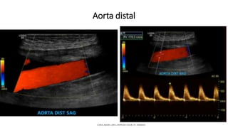 Aorta distal
CAROL KREBS. (2001). DOPPLER COLOR. EU: MARBAN.
 