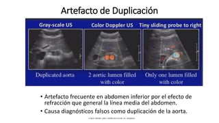 Artefacto de Duplicación
• Artefacto frecuente en abdomen inferior por el efecto de
refracción que general la línea media del abdomen.
• Causa diagnósticos falsos como duplicación de la aorta.
CAROL KREBS. (2001). DOPPLER COLOR. EU: MARBAN.
 