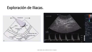 Exploración de Iliacas.
CAROL KREBS. (2001). DOPPLER COLOR. EU: MARBAN.
 