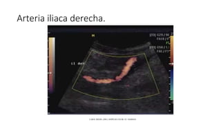 Arteria iliaca derecha.
CAROL KREBS. (2001). DOPPLER COLOR. EU: MARBAN.
 
