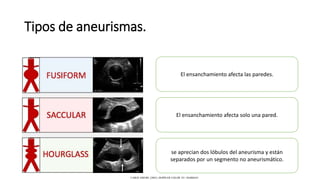 Tipos de aneurismas.
El ensanchamiento afecta las paredes.
El ensanchamiento afecta solo una pared.
se aprecian dos lóbulos del aneurisma y están
separados por un segmento no aneurismático.
CAROL KREBS. (2001). DOPPLER COLOR. EU: MARBAN.
 