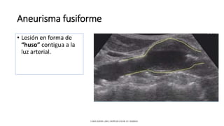 Aneurisma fusiforme
• Lesión en forma de
“huso” contigua a la
luz arterial.
CAROL KREBS. (2001). DOPPLER COLOR. EU: MARBAN.
 