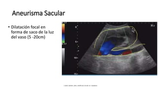 Aneurisma Sacular
• Dilatación focal en
forma de saco de la luz
del vaso (5 -20cm)
CAROL KREBS. (2001). DOPPLER COLOR. EU: MARBAN.
 