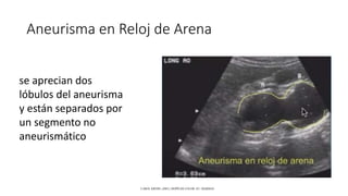 Aneurisma en Reloj de Arena
CAROL KREBS. (2001). DOPPLER COLOR. EU: MARBAN.
se aprecian dos
lóbulos del aneurisma
y están separados por
un segmento no
aneurismático
 