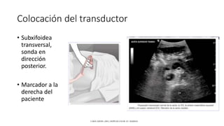 Colocación del transductor
• Subxifoidea
transversal,
sonda en
dirección
posterior.
• Marcador a la
derecha del
paciente
CAROL KREBS. (2001). DOPPLER COLOR. EU: MARBAN.
 