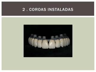 2 . COROAS INSTALADAS

 