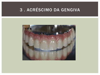 3 . ACRÉSCIMO DA GENGIVA

 