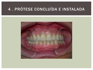 4 . PRÓTESE CONCLUÍDA E INSTALADA

 