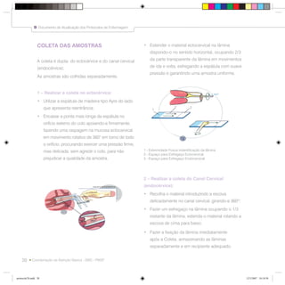 20
Documento de Atualização dos Protocolos de Enfermagem
Coordenação da Atenção Básica - SMS - PMSP
COLETA DAS AMOSTRAS
A coleta é dupla: do ectocérvice e do canal cervical
(endocérvice);
As amostras são colhidas separadamente.
1 – Realizar a coleta no ectocérvice:
• Utilizar a espátula de madeira tipo Ayre do lado
que apresenta reentrância;
• Encaixar a ponta mais longa da espátula no
orifício externo do colo apoiando-a firmemente,
fazendo uma raspagem na mucosa ectocervical
em movimento rotativo de 360° em torno de todo
o orifício, procurando exercer uma pressão firme,
mas delicada, sem agredir o colo, para não
prejudicar a qualidade da amostra.
• Estender o material ectocervical na lâmina
dispondo-o no sentido horizontal, ocupando 2/3
da parte transparente da lâmina em movimentos
de ida e volta, esfregando a espátula com suave
pressão e garantindo uma amostra uniforme.
2 – Realizar a coleta do Canal Cervical
(endocérvice):
• Recolha o material introduzindo a escova
delicadamente no canal cervical, girando-a 360º;
• Fazer um esfregaço na lâmina ocupando o 1/3
restante da lâmina, estenda o material rolando a
escova de cima para baixo;
• Fazer a fixação da lâmina imediatamente
após a Coleta, armazenando as lâminas
separadamente e em recipiente adequado.
Documento de Atualização dos Protocolos de Enfermagem
1 - Extremidade Fosca indentificação da lâmina
2 - Espaço para Esfregaço Ectocervical
3 - Espaço para Esfregaço Endocervical
360o
1
2 3
protocolo7b.indd 20protocolo7b.indd 20 12/3/2007 18:18:5812/3/2007 18:18:58
 