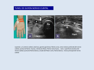 TUNEL DE GUYON NERVIO CUBITAL

Leyenda: a, la arteria cubital, asterisco, gancho ganchoso; flecha curva, rama motora profunda del nervio
cubital, puntas de flecha huecas, retináculo flexor; flecha recta hueca , rama superficial sensitiva del
nervio cubital; punta de flecha blanca, arcade del flexor corto, flecha blanco, tronco principal del nervio
cubital

 