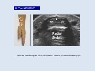 1º COMPARTIMENTO

Leyenda: APL, abductor largo del pulgar; puntas de flecha, retináculo, EPB, extensor corto del pulgar

 