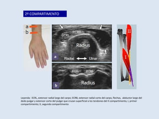 2º COMPARTIMENTO

Leyenda: ECRL, extensor radial largo del carpo; ECRB, extensor radial corto del carpo, flechas, abductor largo del
dedo pulgar y extensor corto del pulgar que cruzan superficial a los tendones del II compartimento, I, primer
compartimiento; II, segundo compartimento

 