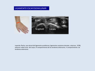 LIGAMENTO ESCAFOSEMILUNAR

Leyenda: flecha, cara dorsal del ligamento escafolunar, ligamentos carpianos dorsales asterisco, ECRB,
extensor radial corto del carpo, IV compartimento de los tendones extensores, V compartimiento de
tendones extensores

 