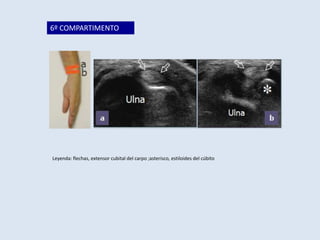 6º COMPARTIMENTO

Leyenda: flechas, extensor cubital del carpo ;asterisco, estiloides del cúbito

 