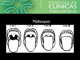 MallampatiMallampati
 