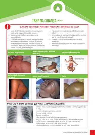 31Avaliação e manejo de pacientes com TB // Versão 1
QUAIS SÃO OS SINAIS DE PERIGO QUE PODEM SER ENCONTRADOS NO RX?
•	 Infitrado difuso nodular de pequeno tamanho (nódulos 1-2 mm) sugestivo de
TB miliar
•	 Envolvimento parenquimatoso extenso
•	 Derrame pleural extenso
•	 Derrame pericárdico
•	 Pobre resposta clínica/radiológica ao tratamento
•	 Todos os casos de TB miliar devem ser submetidos a punção lombar para
citobioquímico e bacteriologia (Xpert MTB/RIF, BK, LPA, Cultura+TSA)
-	 Se meninigite TB excluida: tratar TB por 6 meses
-	 Se meningite TB (ou sem possibilidade de PL): Tratar por 12 meses
TBEP NA CRIANÇA >>>
Distress respiratório
Opistótonos (rigidez de nuca
marcada)
Hepatoesplenomegalia
Deformidade da coluna
vertebral
Edema facial/anasarca Ascite
QUAIS SÃO OS SINAIS DE PERIGO QUE PRECISAM DE REFERÊNCIA DO CASO?
1.	 Sinais de dificuldade respiratória com sinais como
adejo nasal, tiragem intercostal, cianose
2.	 Sibilos que não melhoram com tratamento
broncodilatador
3.	 Cefaléia (especialmente quando acompanhada de
vómitos que podem indicar elevação de pressão
intracraniana) irritabilidade, alteração do nível de
consciência, rigidez de nuca, convulsões. Todos estes
podem ser sinais de TB meníngea
4.	 Hepatoesplenomegalia (possível TB disseminada/
miliar)
5.	 Deformidade da coluna vertebral como Giba (possível
Mal de Pott=TB óssea de coluna)
6.	 Dispneia e edema periférico (possível derrame
pericárdico)
7.	 Abdomem distendido com/sem ascite (possível TB
abdominal)
 