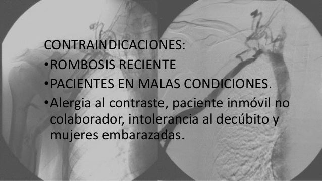 La ampliación varicosa mkb 10