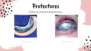 B U C A L E S O C U L A R E S
Protectores
Pueden ser externas o endocavitarios:
 