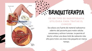 BRAQUITERAPIA
ES UN TIPO DE RADIOTERAPIA
UTILIZADA PARA TRATAR EL
CÁNCER
Se coloca una fuente de material radioactivo
adentro del paciente para matar células
cancerosas y achicar tumores. Le permite al
doctor utilizar una dosis total de radiación más
alta para tratar una área más pequeña en menos
tiempo.
 