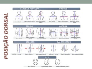 PÉS
arco normal ligeiramente plano acentuadamente plano
retilínio à frente ligeiro desvio acentuado desvio retilíneo à frente ligeira abdução acentuada abdução
sem desvio
ligeira curvatura
lateral
acentuada
curvatura lateral
sem desvio ligeiro desvio lateral
acentuado desvio
lateral
JOELHOS CALCANHARES
COLUNA QUADRIL
CABEÇA E PESCOÇO OMBROS
sem desvio
ligeiro desvio lateral acentuado desvio
lateral
sem desvio ligeiro desvio lateral acentuado desvio
lateral
 