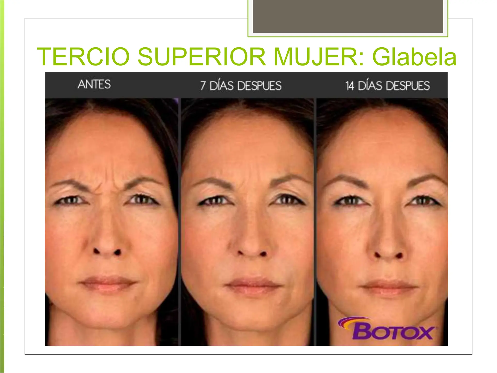 protocolos-de-aplicacion-toxina-botulinica.pptx