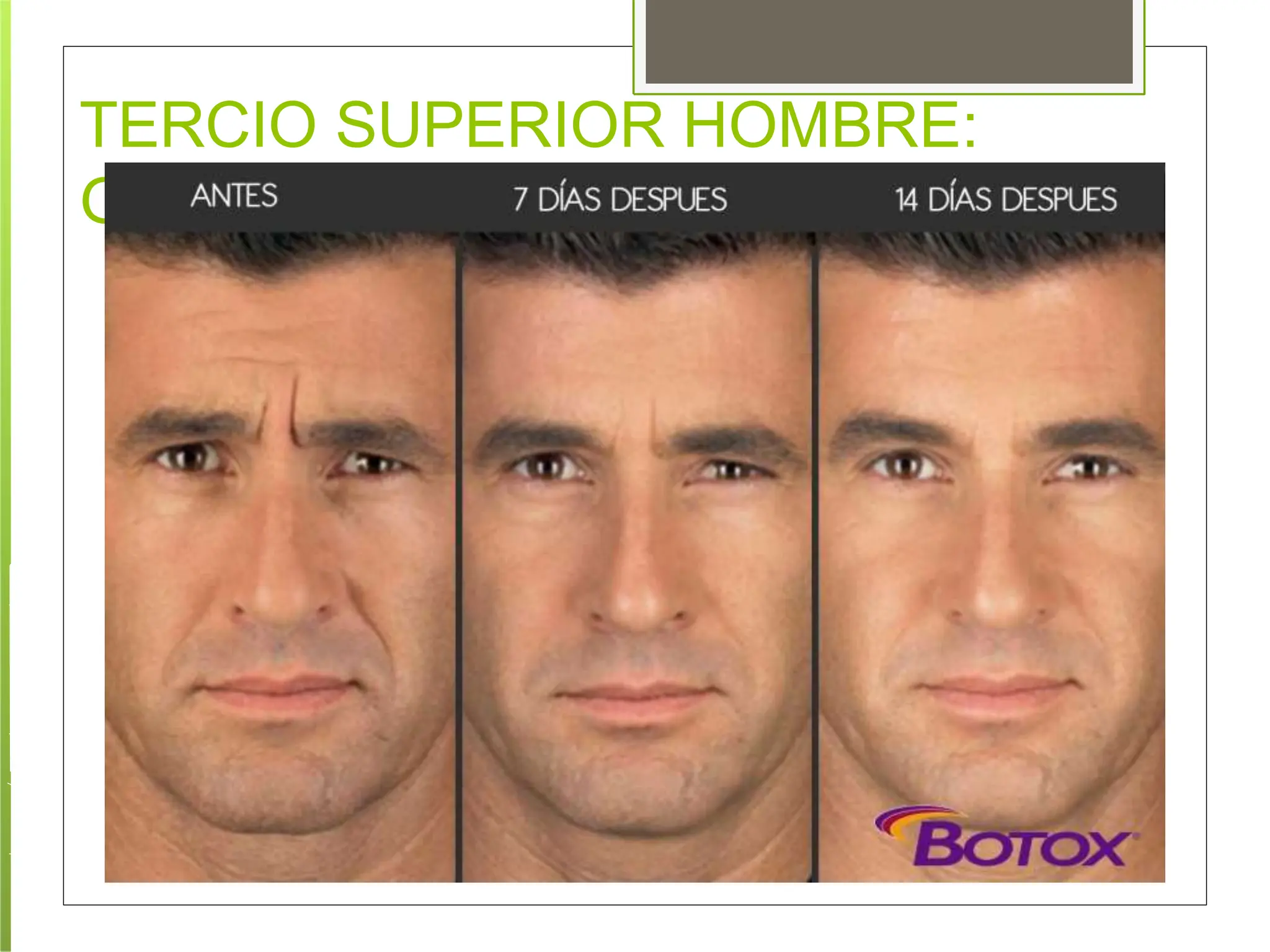 protocolos-de-aplicacion-toxina-botulinica.pptx