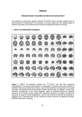 ANEXO III:
PRESENTACIÓN Y DOCUMENTACIÓN DE ESTUDIOS SPECT
Se presentan a continuación algunos estudios de SPECT bajo el formato sugerido para su
documentación e interpretación. Sin embargo, el formato puede ser muy variable según el
software disponible y las preferencias del médico encargado de reportar el estudio.
1.- SPECT DE PERFUSIÓN CEREBRAL.

Figura 1. SPECT de perfusión cerebral con 99mTc-ECD. Las dos filas superiores
corresponden a los cortes transversales (o transaxiales), de abajo hacia arriba (desde el
cerebelo hasta la convexidad del cerebro). Las tres filas centrales corresponden a los cortes
coronales, de adelante hacia atrás (desde el lóbulo frontal hasta el occipital). Las dos filas
inferiores corresponden a los cortes sagitales, desde el temporal derecho al temporal
izquierdo. En la esquina inferior derecha de cada plano aparece una imagen de referencia
indicando el rango de cortes tomográficos. Las dos columnas de la derecha corresponden a
imágenes de la reconstrucción 3D de superficie (cortesía Servicio de Medicina Nuclear,
AEPSM, Montevideo, Uruguay).

96

 