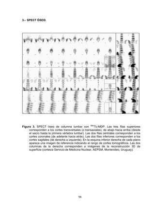 3.- SPECT ÓSEO.

Figura 3. SPECT óseo de columna lumbar con 99mTc-MDP. Las tres filas superiores
corresponden a los cortes transversales (o transaxiales), de abajo hacia arriba (desde
el sacro hasta la primera vértebra lumbar). Las dos filas centrales corresponden a los
cortes coronales (de adelante hacia atrás). Las dos filas inferiores corresponden a los
cortes sagitales (de derecha a izquierda). En la esquina inferior derecha de cada plano
aparece una imagen de referencia indicando el rango de cortes tomográficos. Las dos
columnas de la derecha corresponden a imágenes de la reconstrucción 3D de
superficie (cortesía Servicio de Medicina Nuclear, AEPSM, Montevideo, Uruguay).

98

 