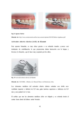 41
Fig.14 Aparato Herbst
Obtenido de: http://www.sonriecentral.com/bco/wp-content/uploads/2013/05/Herbst-Appliance.pdf
Activador abierto elástico (AAE) de Klammt
Este aparato bimaxilar, es muy eficaz gracias a su reducido tamaño y carece casi
totalmente de estabilización, lo que proporciona íntima interacción con la lengua y
favorece la fonación, que lo hace muy aceptado por los niños.
Fig. 15 Activador abierto elástico de Klammt.
Obtenido de: ÁLVAREZ, Alfredo.et al. Manual Clínico de Ortodoncia, Cuba.
Los elementos metálicos del activador abierto elástico estándar son: doble arco
vestibular (superior e inferior) de 0,9 mm, guías incisivas superiores e inferiores de 0,9
mm y arco palatal de 1,2 mm.
El acrílico que une los elementos metálicos debe ser delgado y se extiende desde el
canino hasta distal del último molar brotado.
 