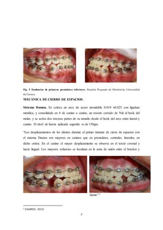 7
Fig. 5 Exodoncias de primeros premolares inferiores. Paciente Posgrado de Ortodoncia, Universidad
de Cuenca.
MECÁNICA DE CIERRE DE ESPACIOS
Sistema Damon. Se coloca un arco de acero inoxidable 0.019 x0.025 con ligadura
metálica, y consolidada en 8 de canino a canino, un resorte cerrado de Niti al hook del
molar, y se activa dos terceras partes de su tamaño desde el hook del arco entre lateral y
canino. El nivel de fuerza aplicada sugerida es de 150gm.
“Los desplazamientos de los dientes durante el primer instante de cierre de espacios con
el sistema Damon son mayores en caninos que en premolares, centrales, laterales, en
dicho orden. En el canino el mayor desplazamiento se observa en el tercio coronal y
hacia lingual. Los mayores esfuerzos se localizan en la zona de unión entre el bracket y
diente”.2
2 (FAJARDO, 2012)
 