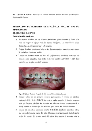 8
Fig. 5 Cierre de espacios. Retracción de caninos inferiores. Paciente Posgrado de Ortodoncia,
Universidad de Cuenca.
PROTOCOLOS DE TRATAMIENTOS ESPECÍFICOS PARA EL TIPO DE
MALOCLUSIÓN
PROTOCOLO D-GAINER
Secuencia del tratamiento:
1. Se colocan brackets en los incisivos permanentes para alinearlos y formar con
ellos un bloque de apoyo para las fuerzas ultraligeras. La alineación de estos
dientes lleva por lo general de 4 a 8 semanas.
2. Colocar brackets con torque bajo en los dientes anteriores superiores, para tratar
de proinclinar lo menos posible.
3. Colocar un alambre 0.014 de NiTi SE (superelástico) seccional, hasta que los
incisivos estén alineados, para poder recibir un alambre del 0.014 × .025. Los
intervalos de las citas son de 8 semanas.
Fig. 6 D-Gainer. Paciente Posgrado de Ortodoncia, Universidad de Cuenca.
4. Colocar tubos en los primeros molares permanentes, y colocar un alambre
continuo 0.014 × 0.025 NiTi SE de molar a molar, dejando el alambre un poco
largo por la parte distal de los tubos de los primeros molares permanentes (4 o
5mm). Esperar el tiempo que sea necesario para alinear los dientes anteriores.
5. En esta cita se coloca un resorte abierto de NiTi SE (mediano) en ambos lados,
que va desde la parte mesial del tubo del primer molar permanente hasta la parte
mesial del bracket del incisivo lateral del mismo lado; esperar 8 semanas para la
 
