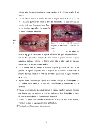 9
próxima cita. La activación debe ser como máximo de 1 a 1½ del tamaño de un
bracket.
6. En esta cita se cambia el alambre por uno de mayor calibre, 0.018 × 0.025 de
NiTi SE; éste permanecerá hasta el final del tratamiento. La activación de los
resortes será cada 8 semanas, hasta llegar
a los objetivos marcados. La activación
se realiza con topes crimpables
Fig. 7
D- Gainer. Resorte de NiTi SE .Paciente
Posgrado de Ortodoncia, Universidad de
Cuenca.
7. En las citas de
revisión hay que ir observando el espacio necesario. Se gana aproximadamente 1
mm por lado por cada 8 semanas. Se debe activar el aparato las veces que sea
necesario, cuidando siempre el tiempo entre cita y cita. Aquí los molares
permanentes ya se están rotando a clase I.
8. En la próxima cita de revisión 8 semanas después, podemos ver cómo se va
ganando el espacio requerido para la erupción de los caninos. Durante todo el
proceso hay que observar el perfil del paciente y cuidar que el ángulo nasolabial
no se cierre.
9. Algunas veces tendremos que esperar un poco más para que se dé la erupción de
los caninos; serán citas en las que sólo observaremos y esperaremos por la
erupción.
10. Cita de observación. Es importante revisar el espacio creado y mantener presente
que durante todo este proceso, el perfil del paciente no debe de cambiar. A partir
de esta cita se comienza el tratamiento de ortodoncia.
11. En esta cita ya se está realizando el tratamiento de ortodoncia en ambas arcadas,
y está en la etapa de reposicionamiento de brackets.
12. Terminación del tratamiento de ortodoncia.
 