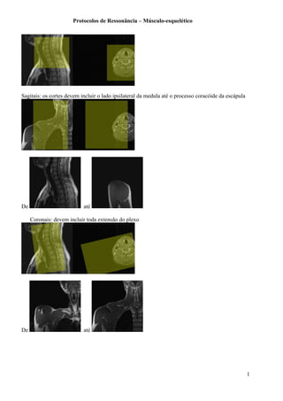 Protocolos de Ressonância – Músculo-esquelético
Sagitais: os cortes devem incluir o lado ipsilateral da medula até o processo coracóide da escápula
De até
Coronais: devem incluir toda extensão do plexo
De até
1
 