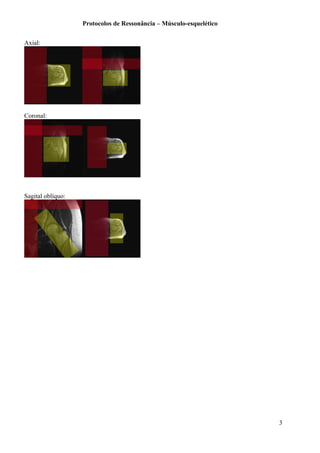 Protocolos de Ressonância – Músculo-esquelético
Axial:
Coronal:
Sagital oblíquo:
3
 