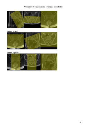Protocolos de Ressonância – Músculo-esquelético
Cortes axiais:
Cortes sagitais:
4
 