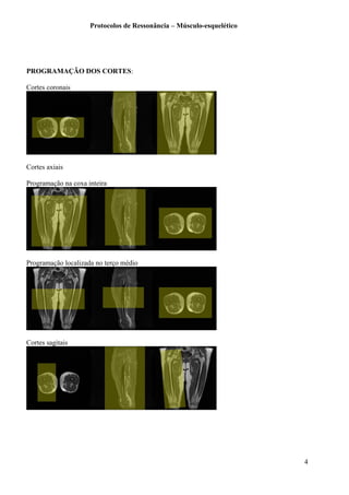 Protocolos de Ressonância – Músculo-esquelético
PROGRAMAÇÃO DOS CORTES:
Cortes coronais
Cortes axiais
Programação na coxa inteira
Programação localizada no terço médio
Cortes sagitais
4
 