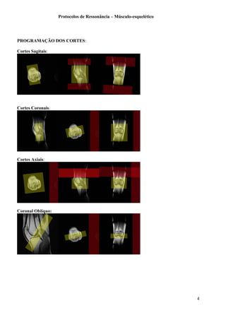 Protocolos de Ressonância – Músculo-esquelético
PROGRAMAÇÃO DOS CORTES:
Cortes Sagitais:
Cortes Coronais:
Cortes Axiais:
Coronal Oblíquo:
4
 