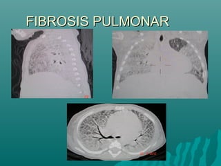 FIBROSIS PULMONARFIBROSIS PULMONAR
 