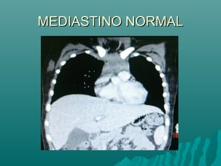 MEDIASTINO NORMALMEDIASTINO NORMAL
 