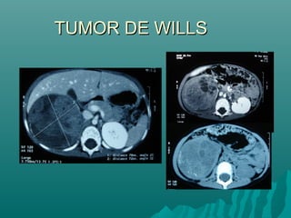 TUMOR DE WILLSTUMOR DE WILLS
 