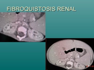 FIBROQUISTOSIS RENALFIBROQUISTOSIS RENAL
 
