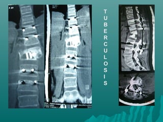 T
U
B
E
R
C
U
L
O
S
I
S
 