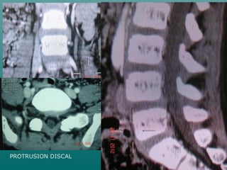PROTRUSION DISCAL
 