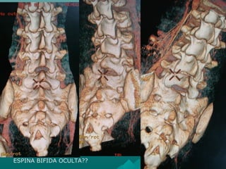 ESPINA BIFIDA OCULTA??
 