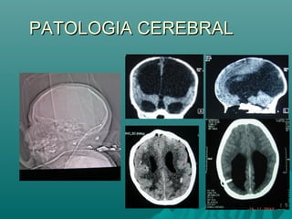 PATOLOGIA CEREBRALPATOLOGIA CEREBRAL
 