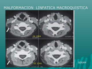 MALFORMACION LINFATICA MACROQUISTICA
SERAM
 