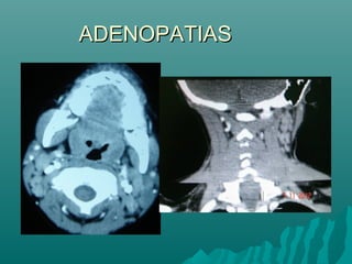 ADENOPATIASADENOPATIAS
 