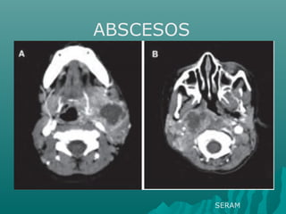 ABSCESOS
SERAM
 